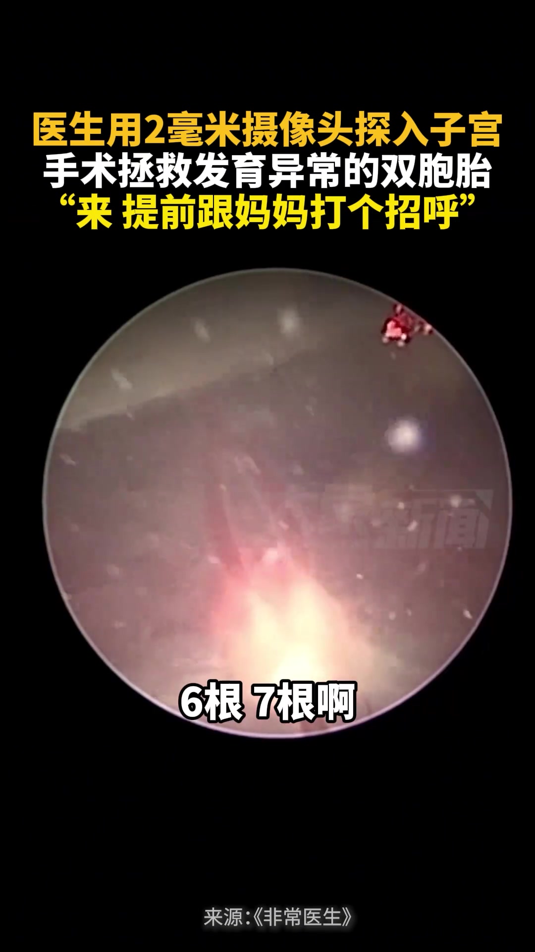 在肚子里给胚胎做手术！不得不感叹医生技术高超和技术的发展！