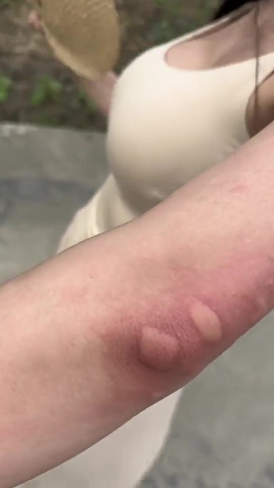 这蚊子也太毒了！咬小姐姐那么大一个包