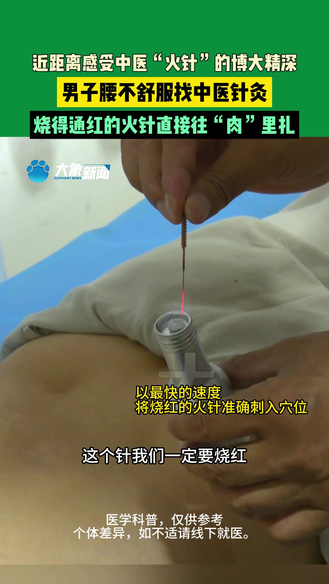 河南郑州，近距离感受中医“火针”的博大精深