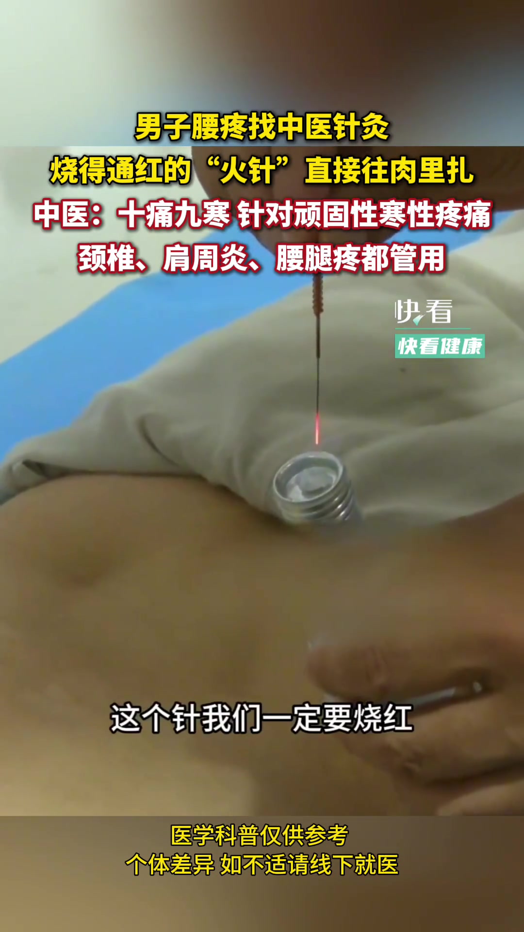 烧得通红的针就这样往肉里扎啦