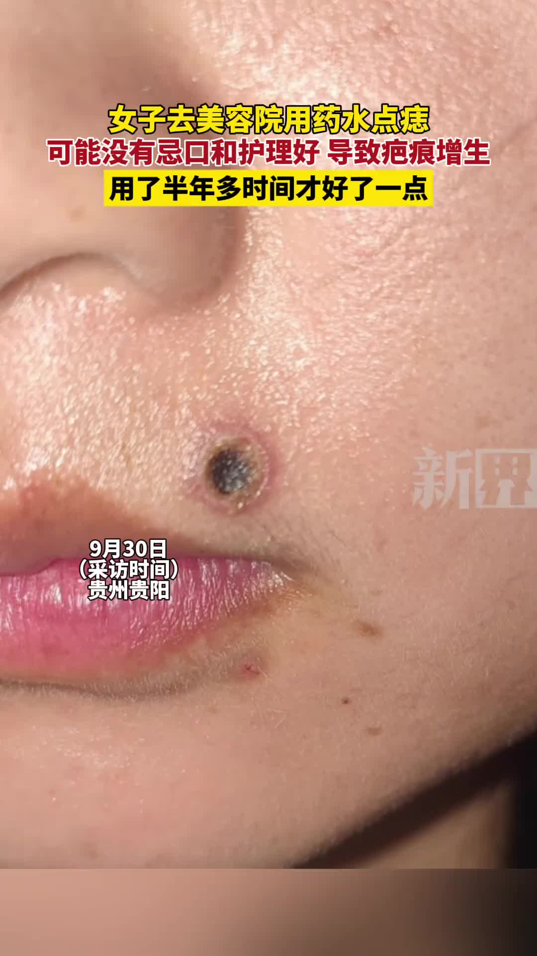 点痣还是要慎重！女子药水点痣导致疤痕增生！