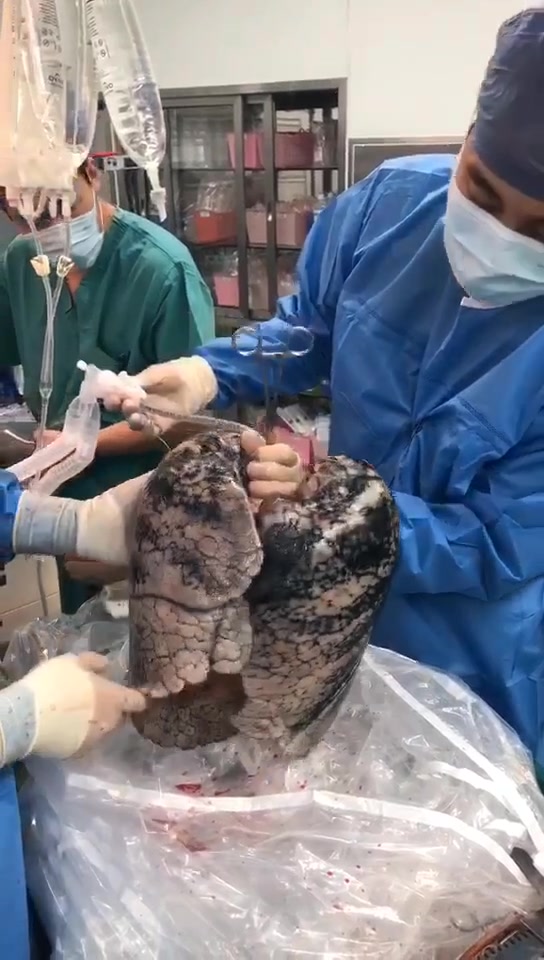 恐怖！团队获取的脑死亡爱心捐献供肺，此供者52岁，近30年烟龄！