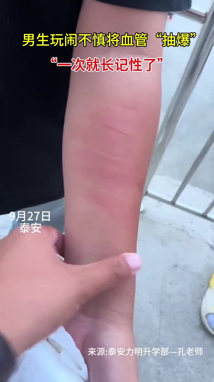 男生玩闹不慎将血管“抽爆”，“一次就长记性了”