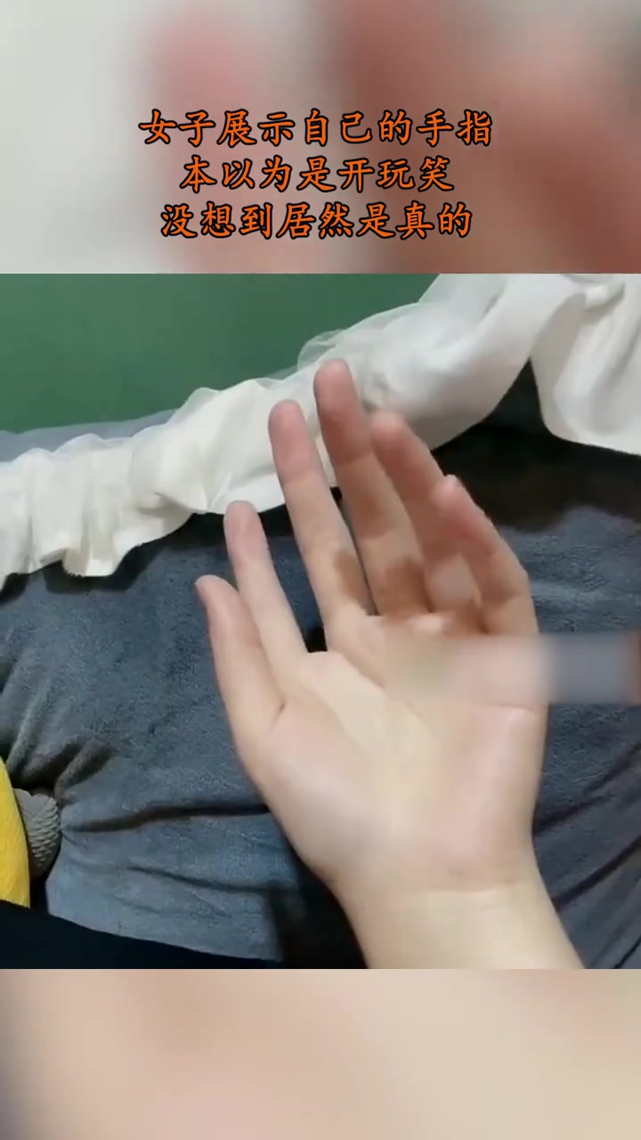 六指琴魔女子展示自己的手指，本以为是开玩笑结果竟然是真的！