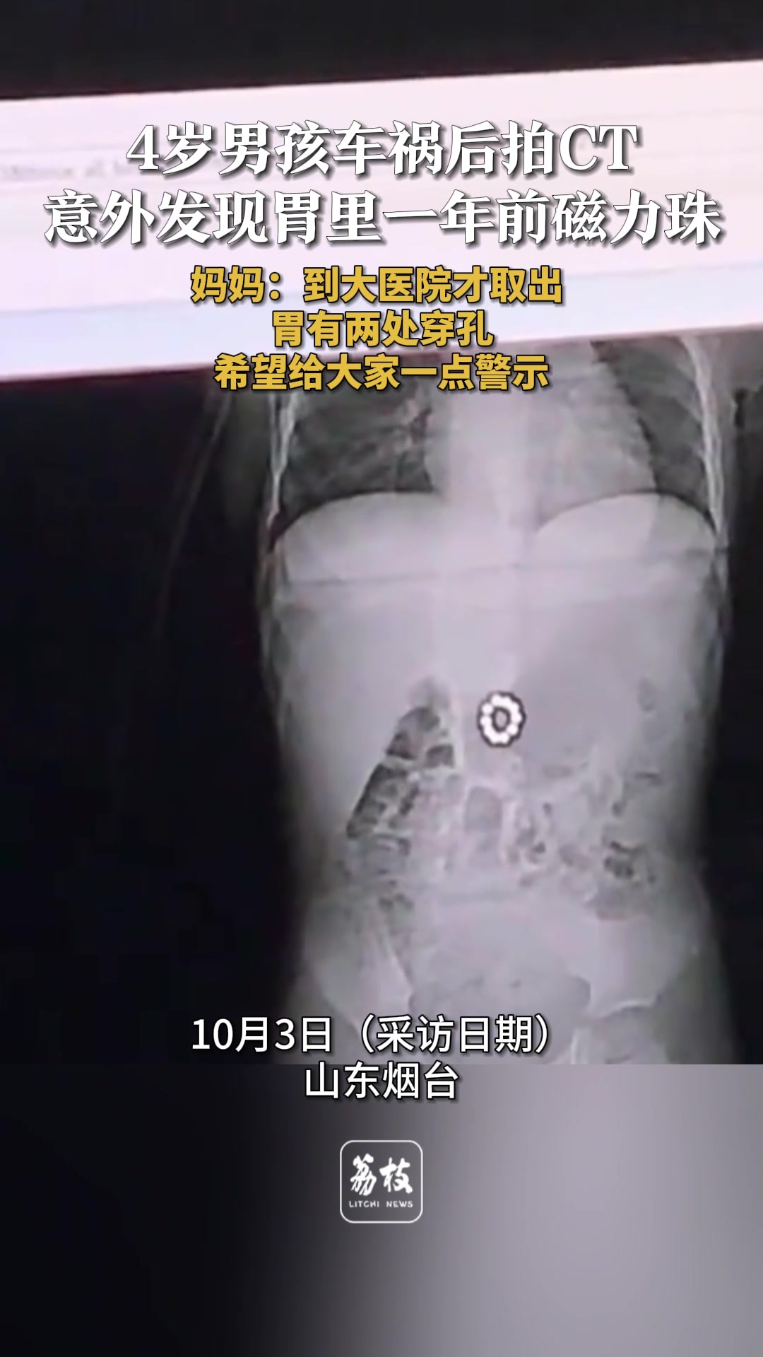 4岁男孩车祸才发现磁力珠藏胃里1年，胃已有两处穿孔