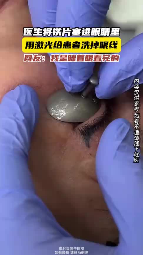 医生将铁片塞进眼睛里，用激光给患者洗掉眼线！看着都害怕