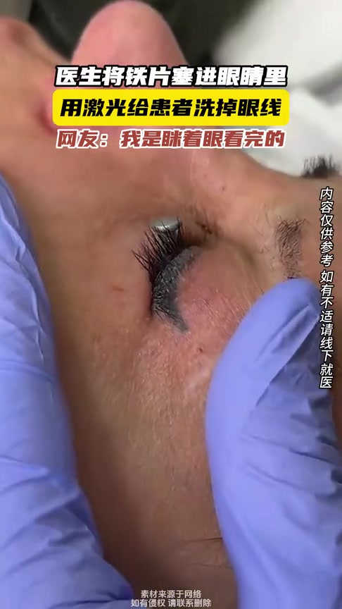 太恐怖！医生将铁片塞进眼睛里！用激光给患者洗掉眼线！