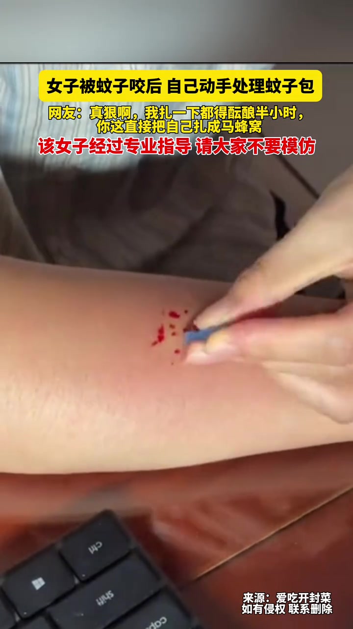 放血疗法！女子被蚊子咬后，自己动手处理蚊子包！蚊子：我没你狠
