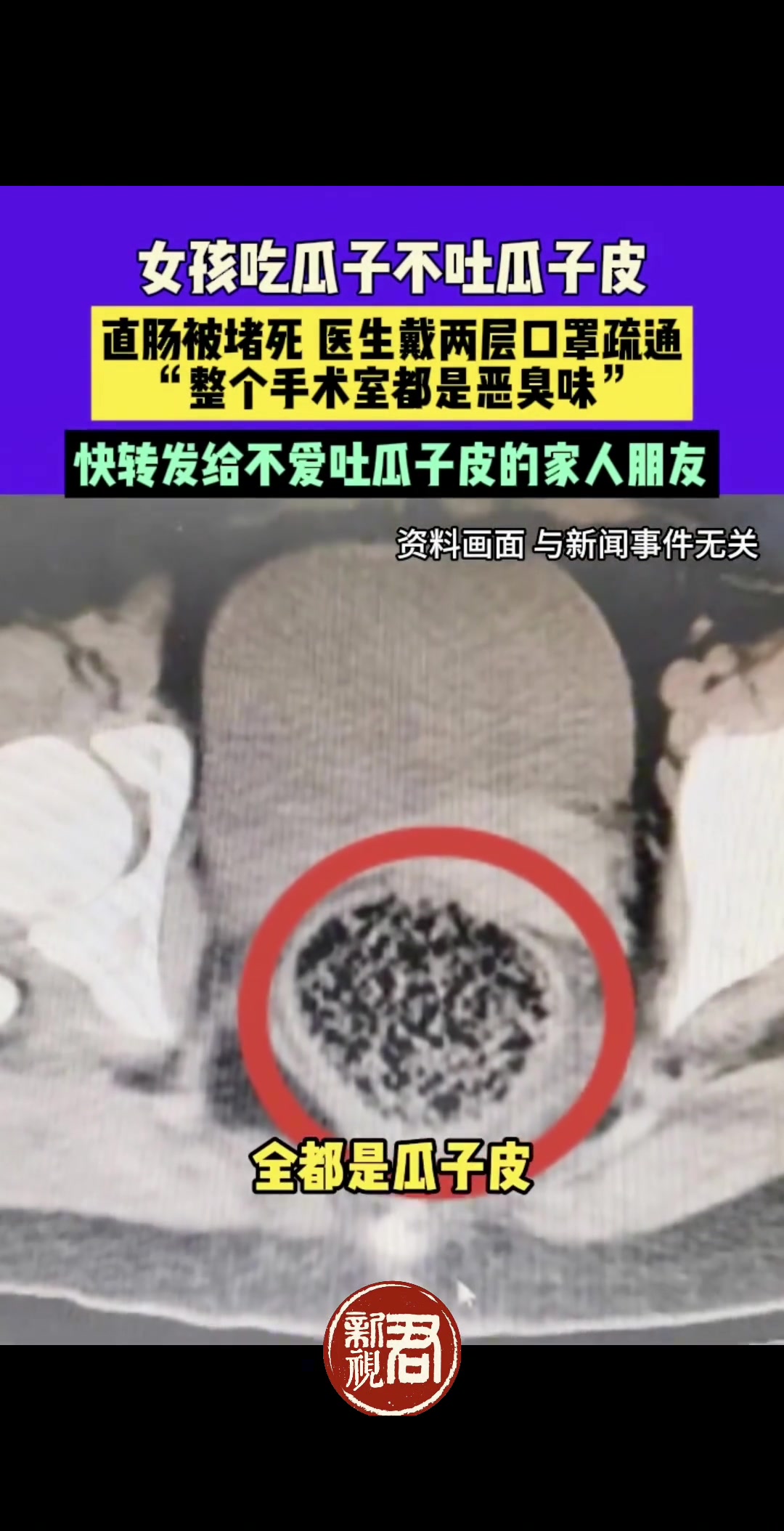 女孩吃瓜子不吐瓜子皮，直肠被堵死，医生戴两层口罩疏通