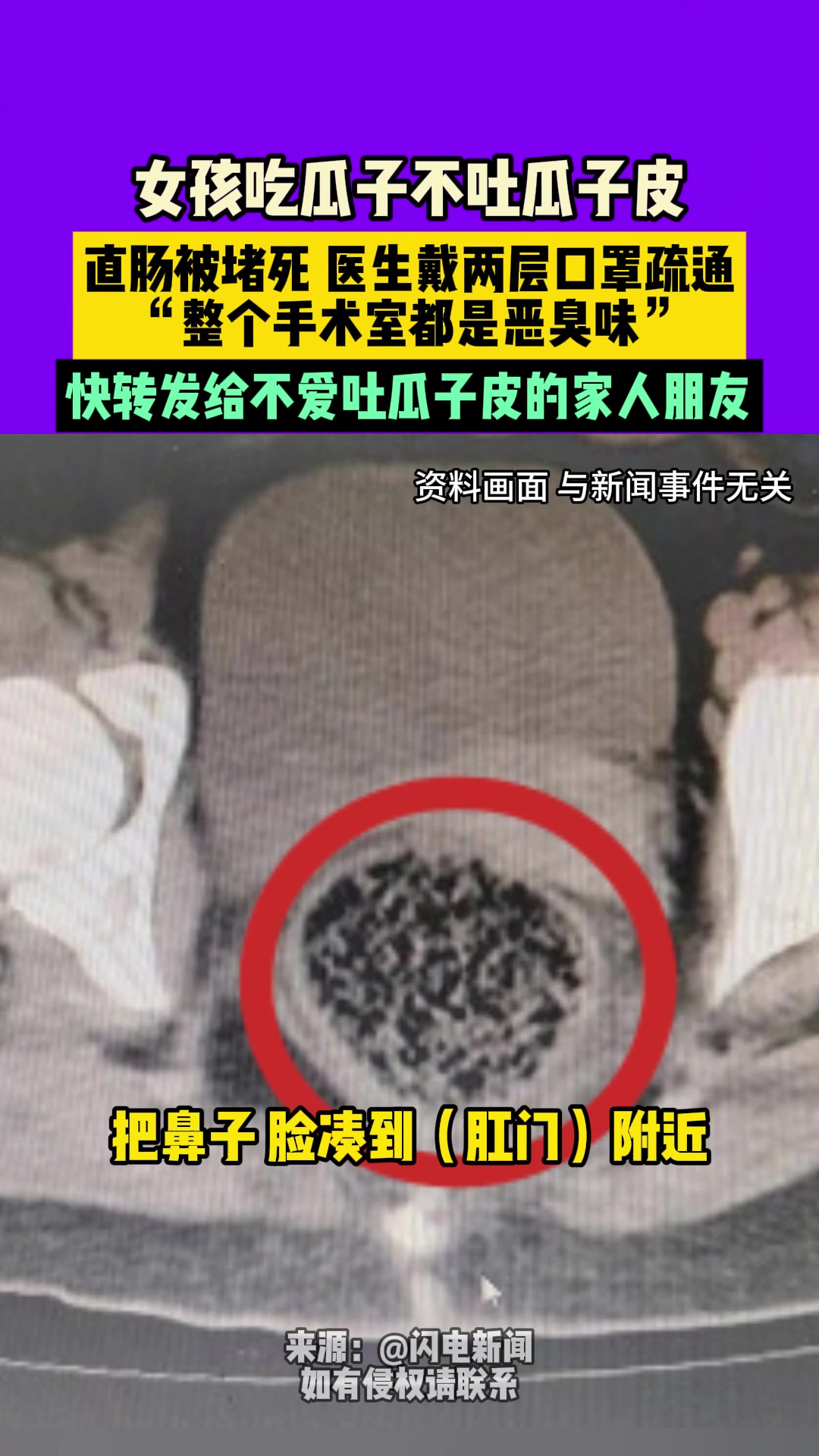 只能做手术！女孩吃瓜子不吐瓜子皮直肠被堵死！