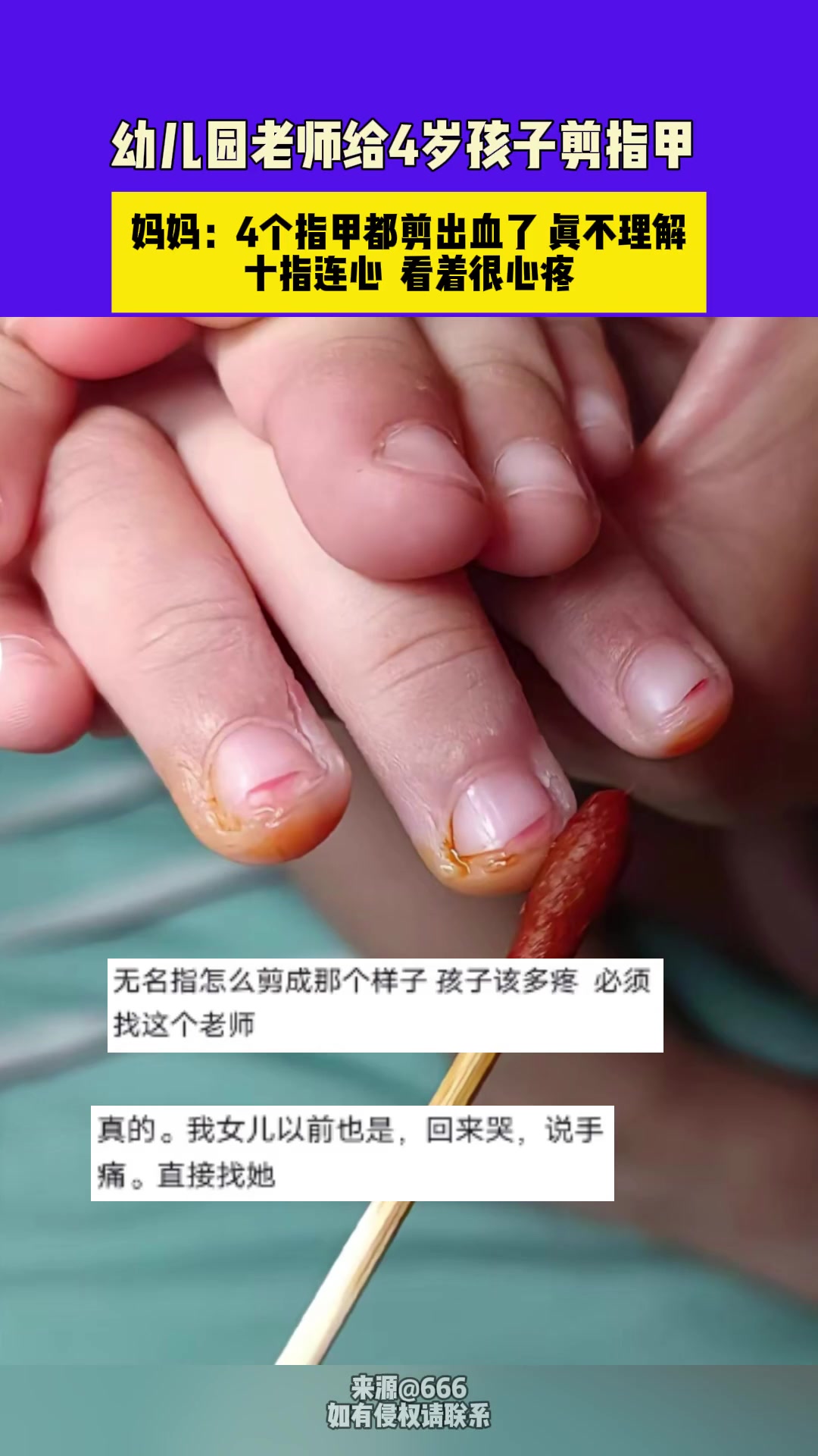 我一个成年人看着都疼，这是幼儿园老师能给孩子剪的指甲