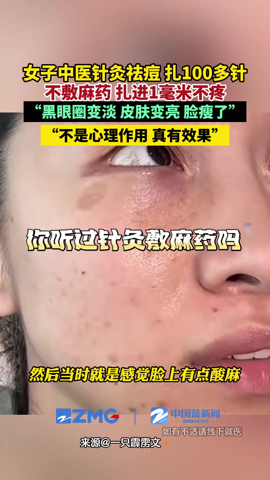 张女士去中医馆针灸祛痘，脸上被扎了一百多针！