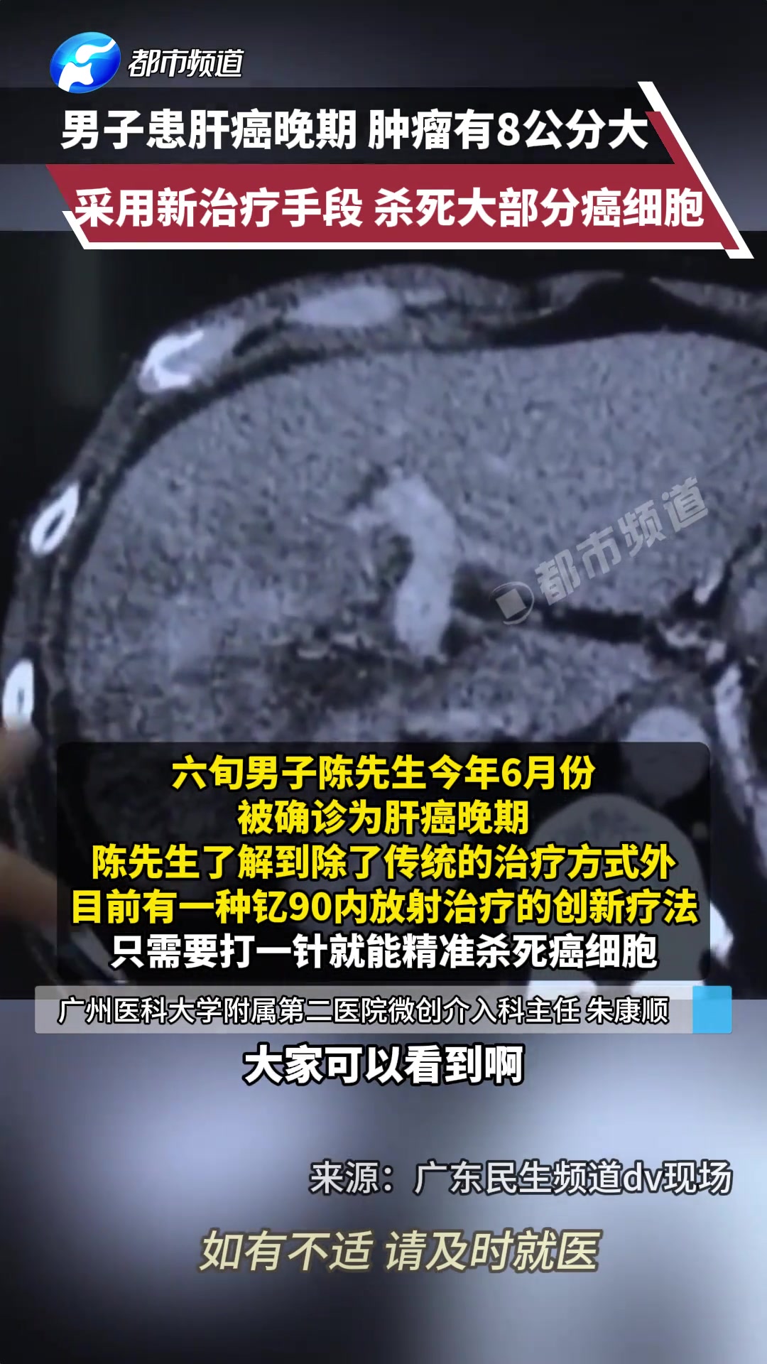 男子患肝癌晚期，采用新治疗手段，杀死大部分癌细胞