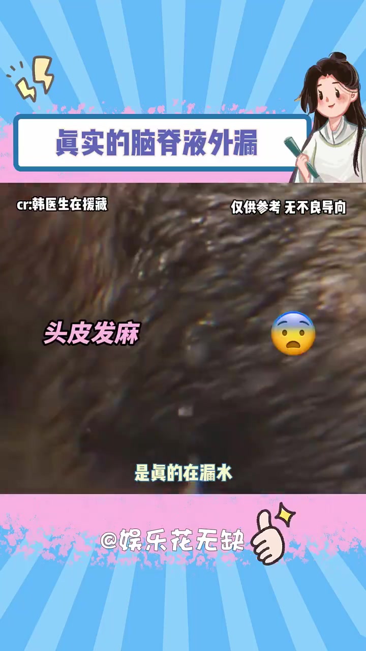 脑脊液外漏好吓人！！