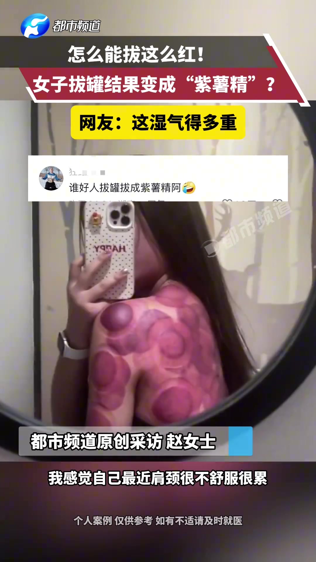 女子拔罐结果变成“紫薯精”?网友这湿气得多重