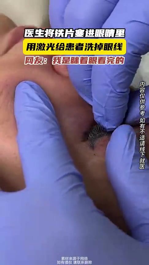 医生将铁片塞进眼睛里，用激光给患者洗掉眼线