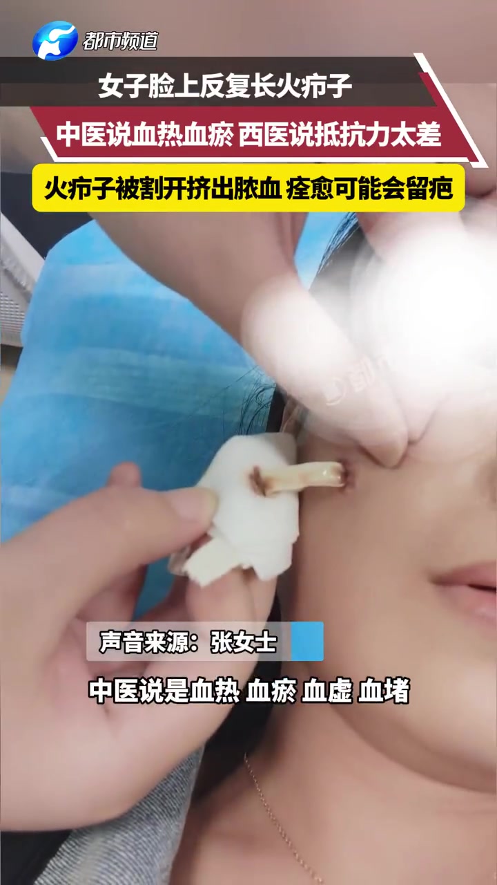 女生脸上反复长火疖子，这也太大了吧
