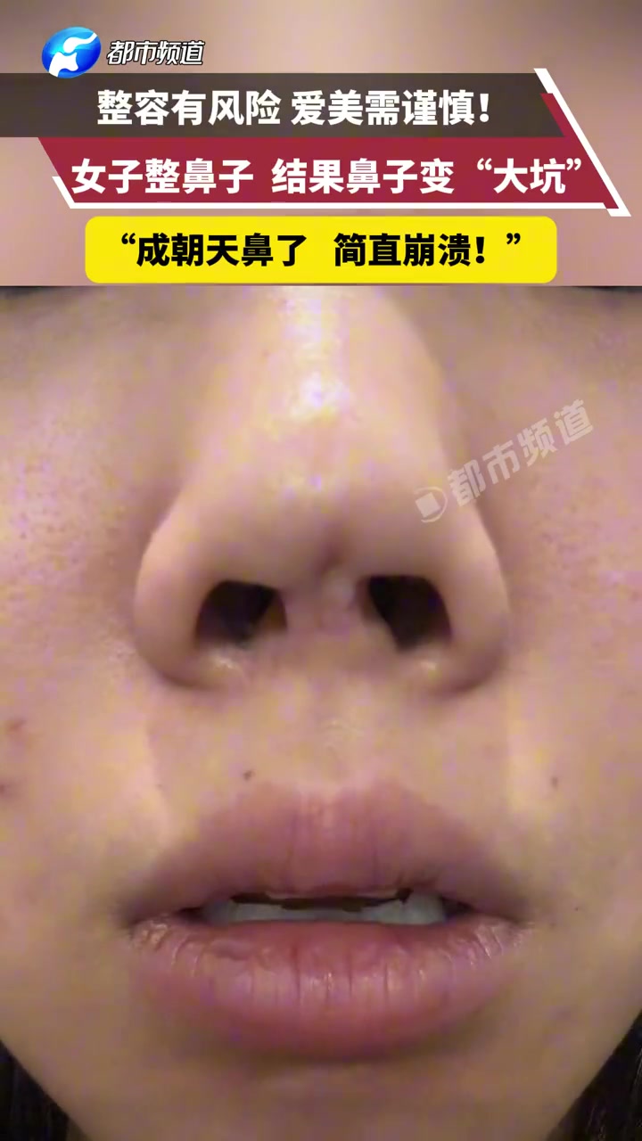 女子整鼻子结果鼻子变“大坑”！