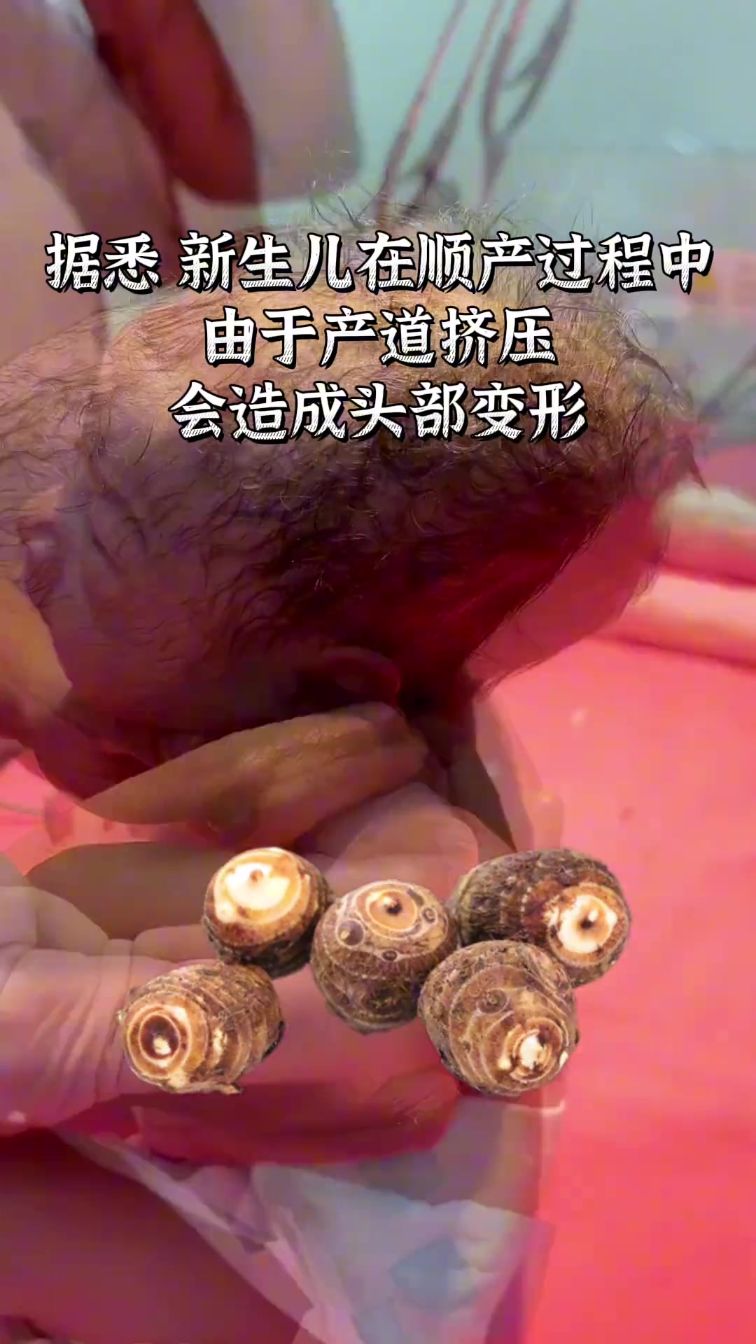 刚出生宝宝头型酷似芋头，医生：被挤了！