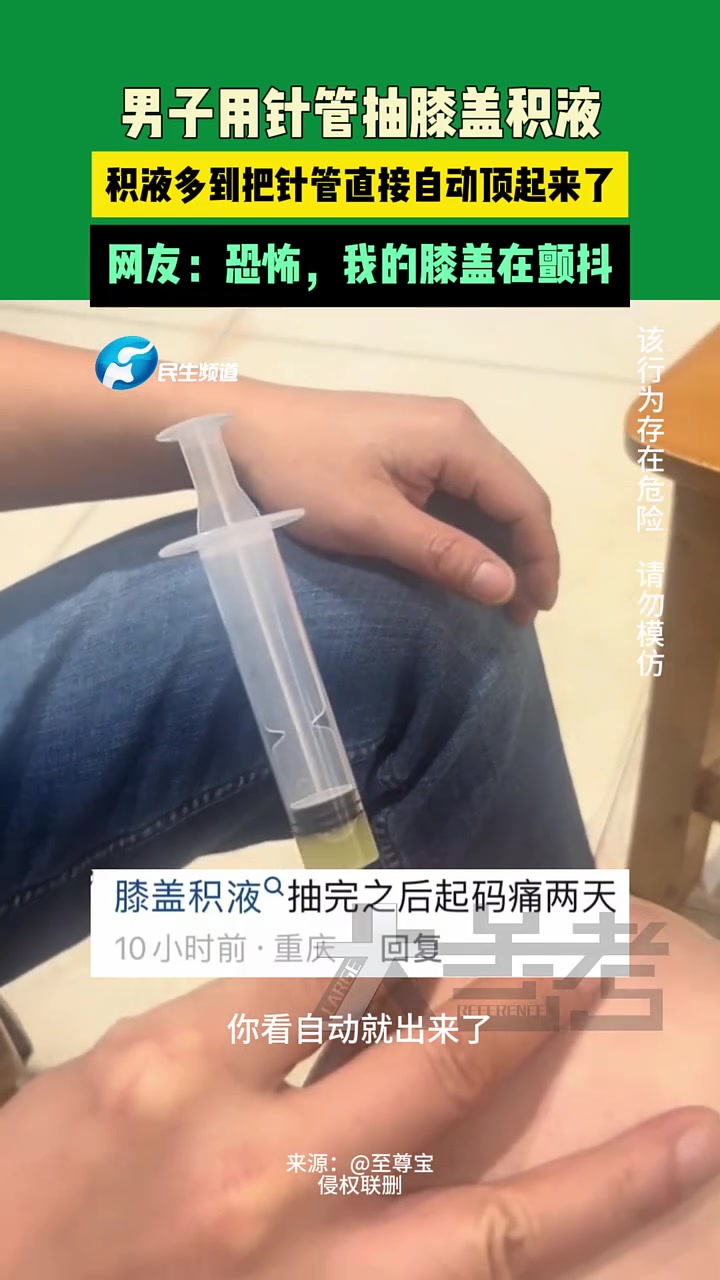 男子用针管抽膝盖积液，积液多到把针管直接自动顶起来了