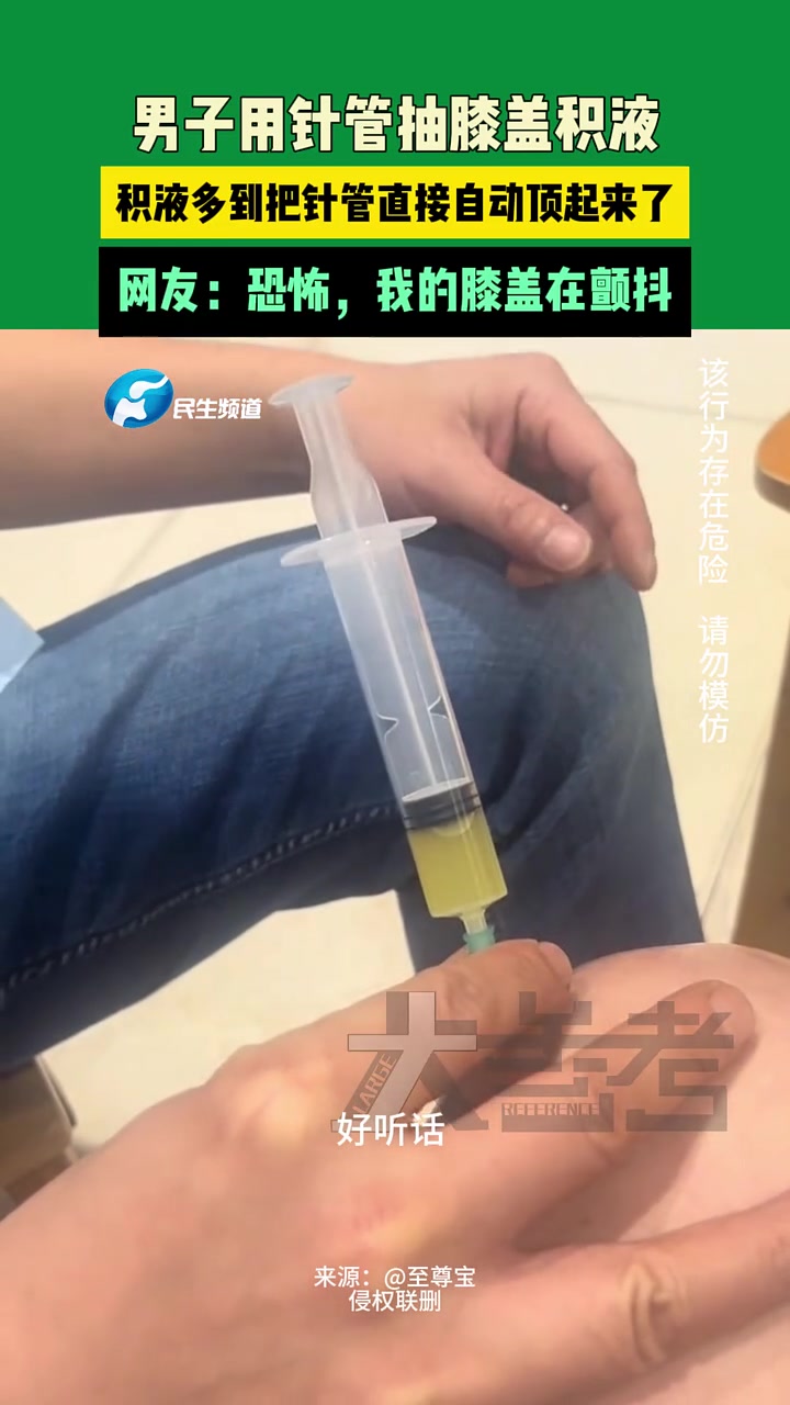 男子用针管抽膝盖积液，积液多到把针管直接自动顶起来了！