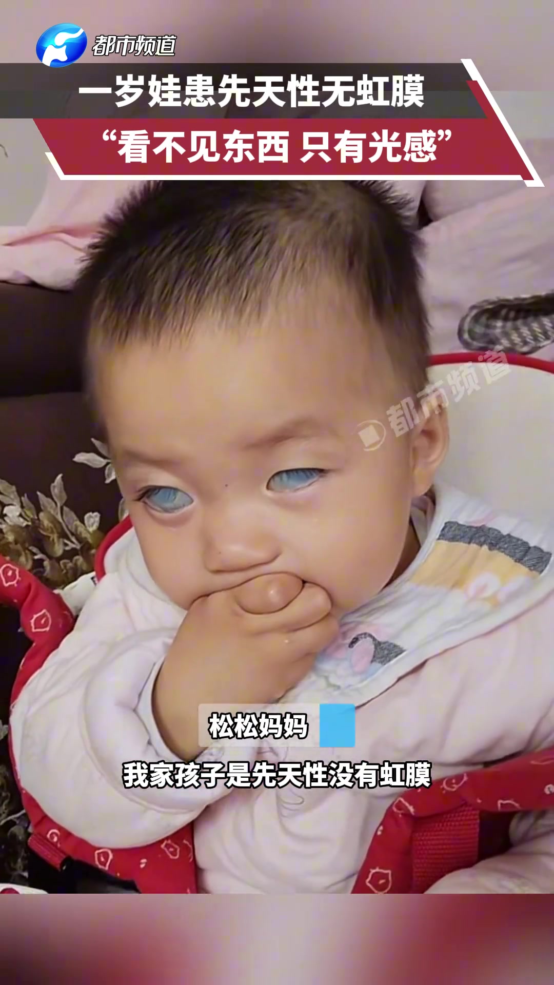 一岁娃患先天性无虹膜“看不见东西只有光感”