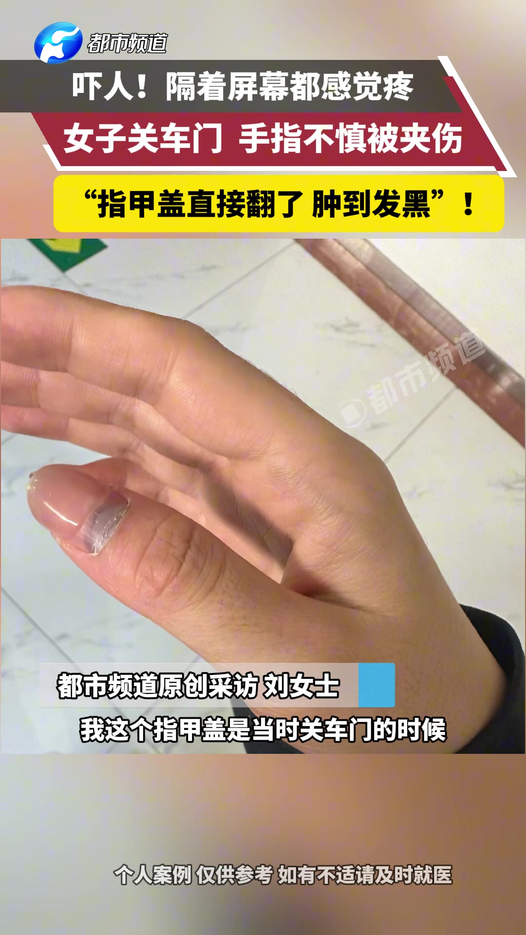 吓人！女子关车门手指不慎被夹伤，指甲盖直接翻了肿到发黑！