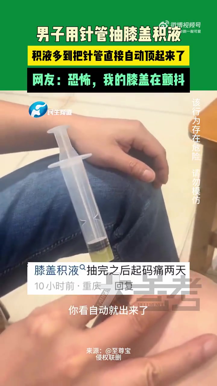 男子用针管抽膝盖积液，积液多到把针管直接自动顶起来了