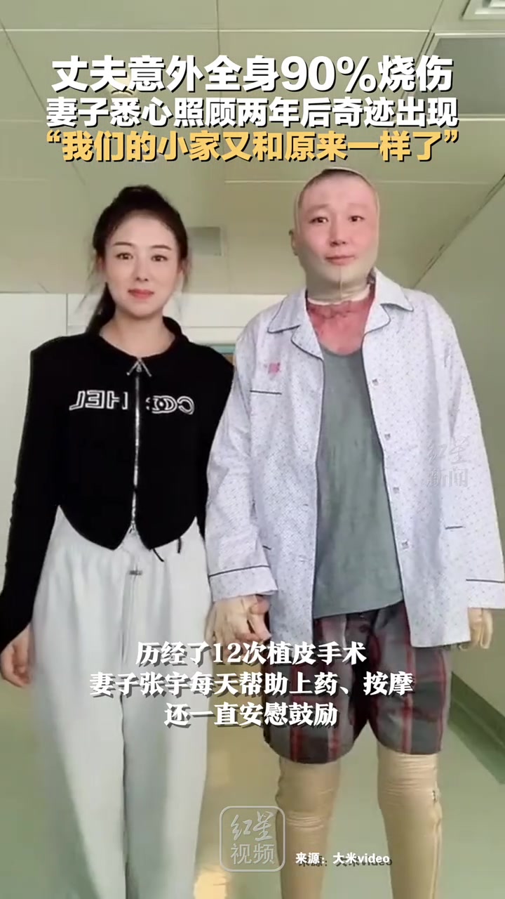 丈夫意外全身90%烧伤，妻子悉心照顾两年后奇迹出现，太不容易了