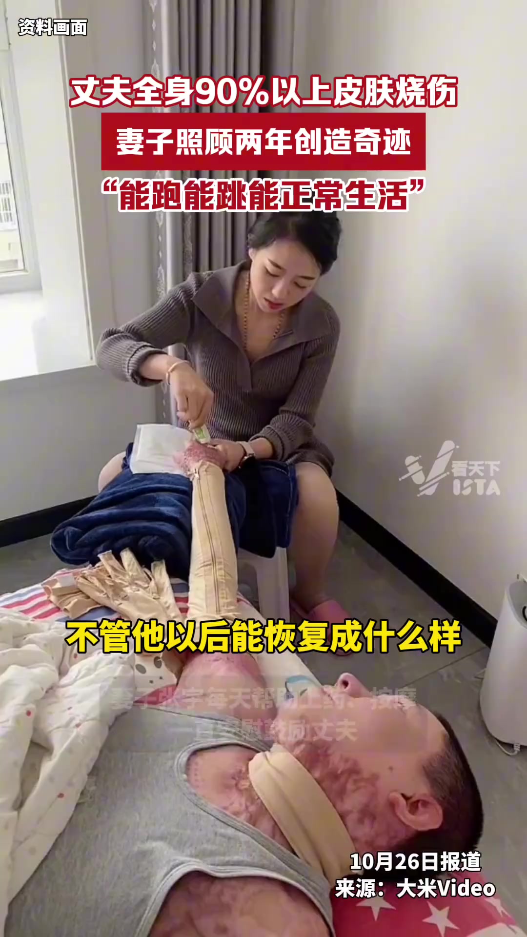 丈夫全身90%%以上皮肤烧伤，妻子不离不弃照顾两年创造奇迹