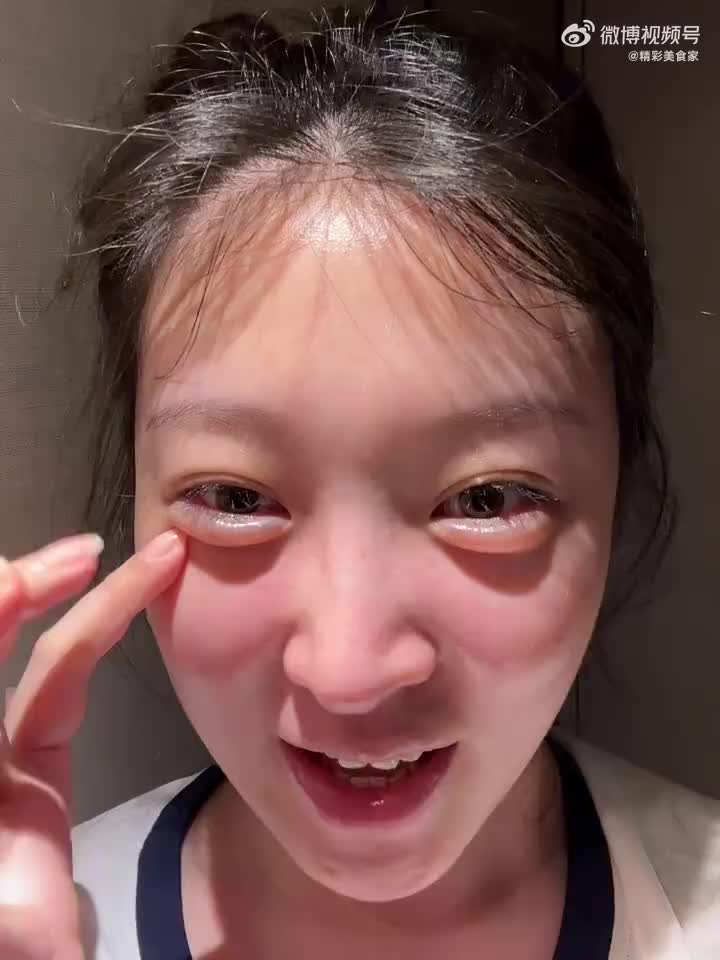 这眼袋咋还透明的呢医美失败了吧像被烫的水泡！