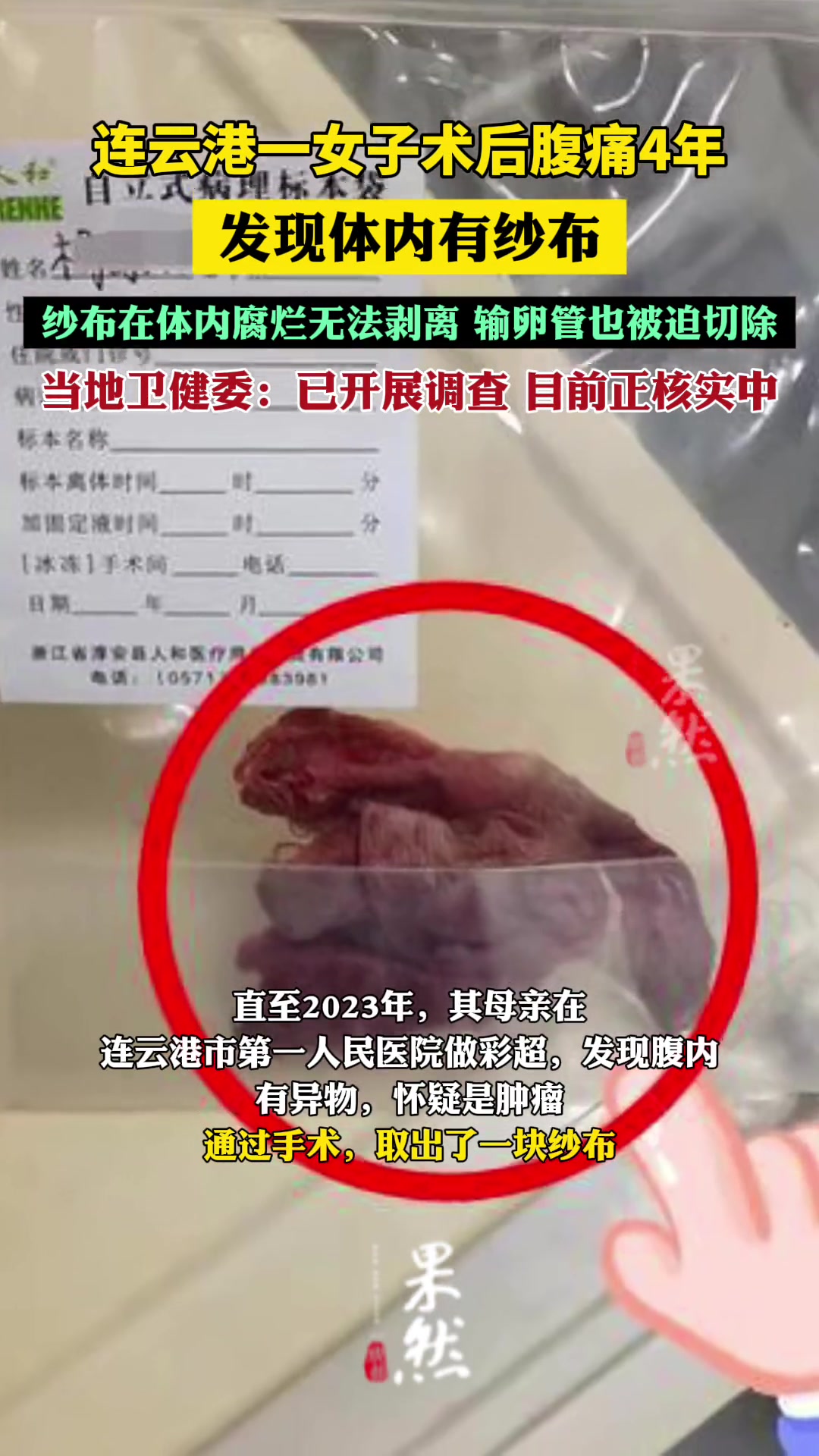 连云港一女子腹痛4年被发现体内有纱布！家属怀疑此前手术遗留