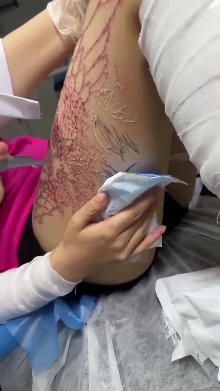把纹身去掉，这得多痛