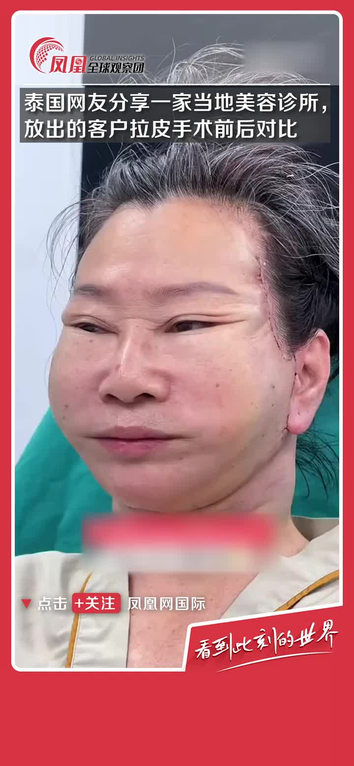 泰国一家美容诊所放出了客户拉皮手术的前后对比图