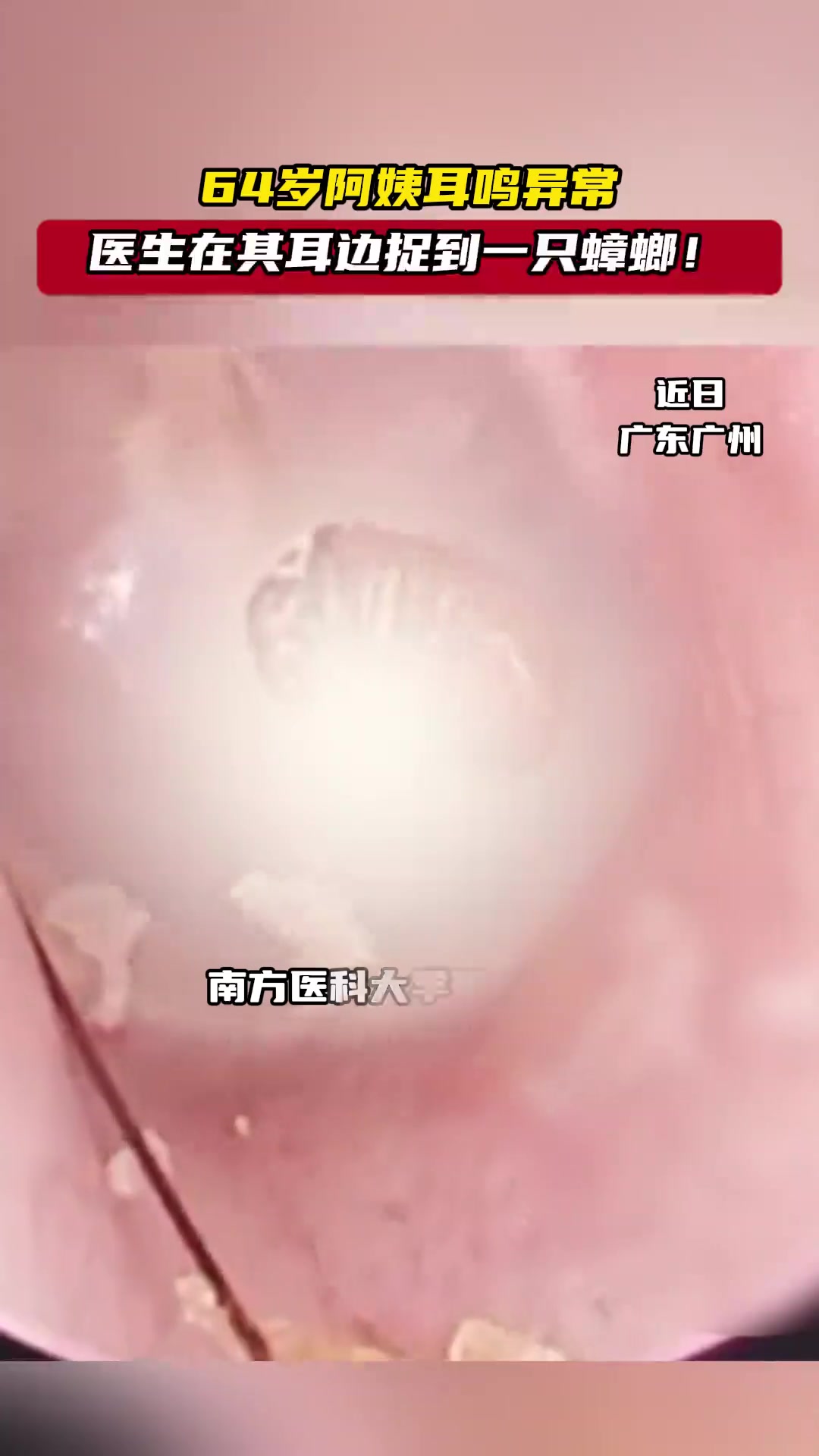 女子耳鸣得厉害，耳道中竟取出一只活蟑螂