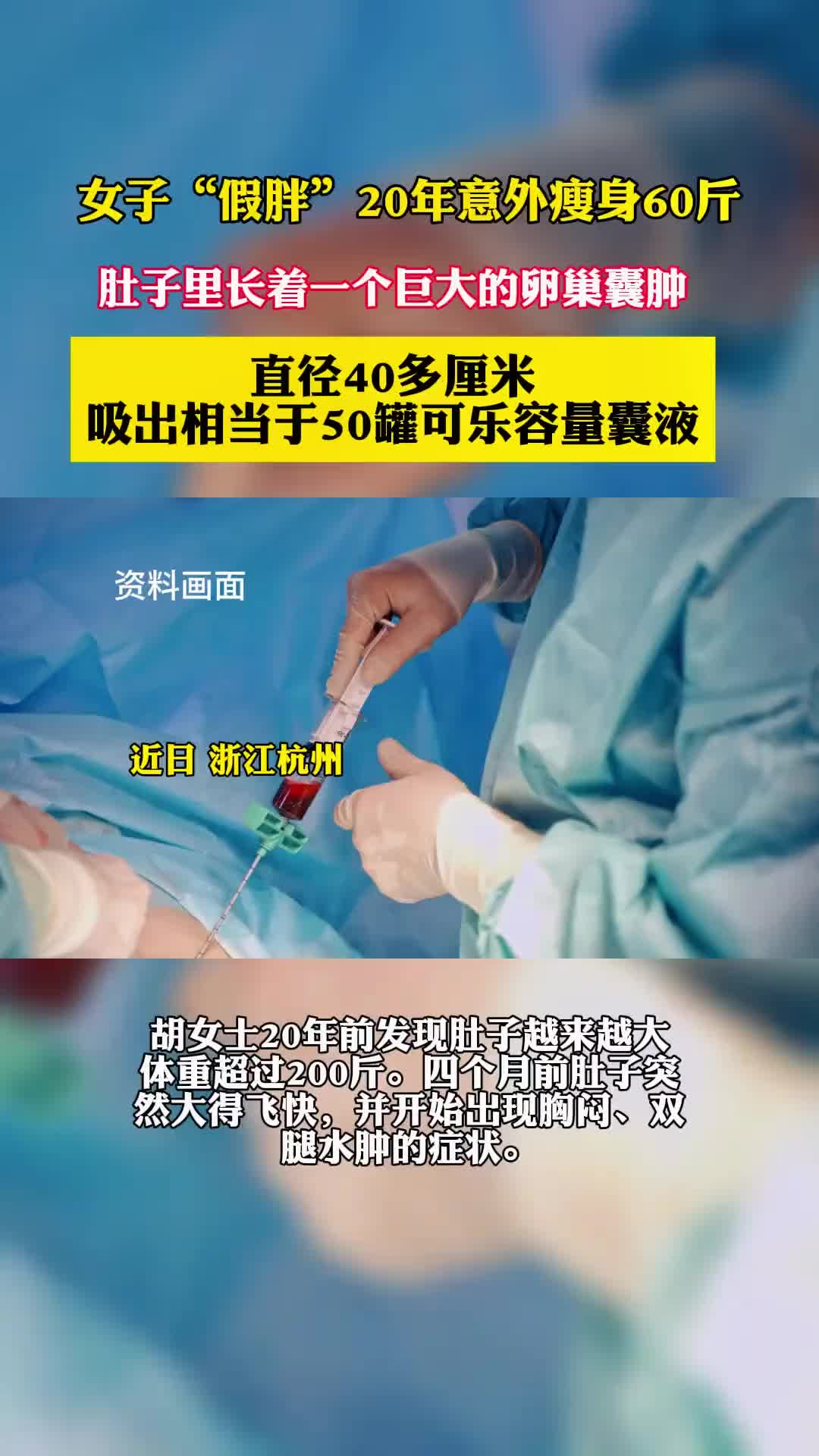 女子”假胖“20年意外瘦身60斤