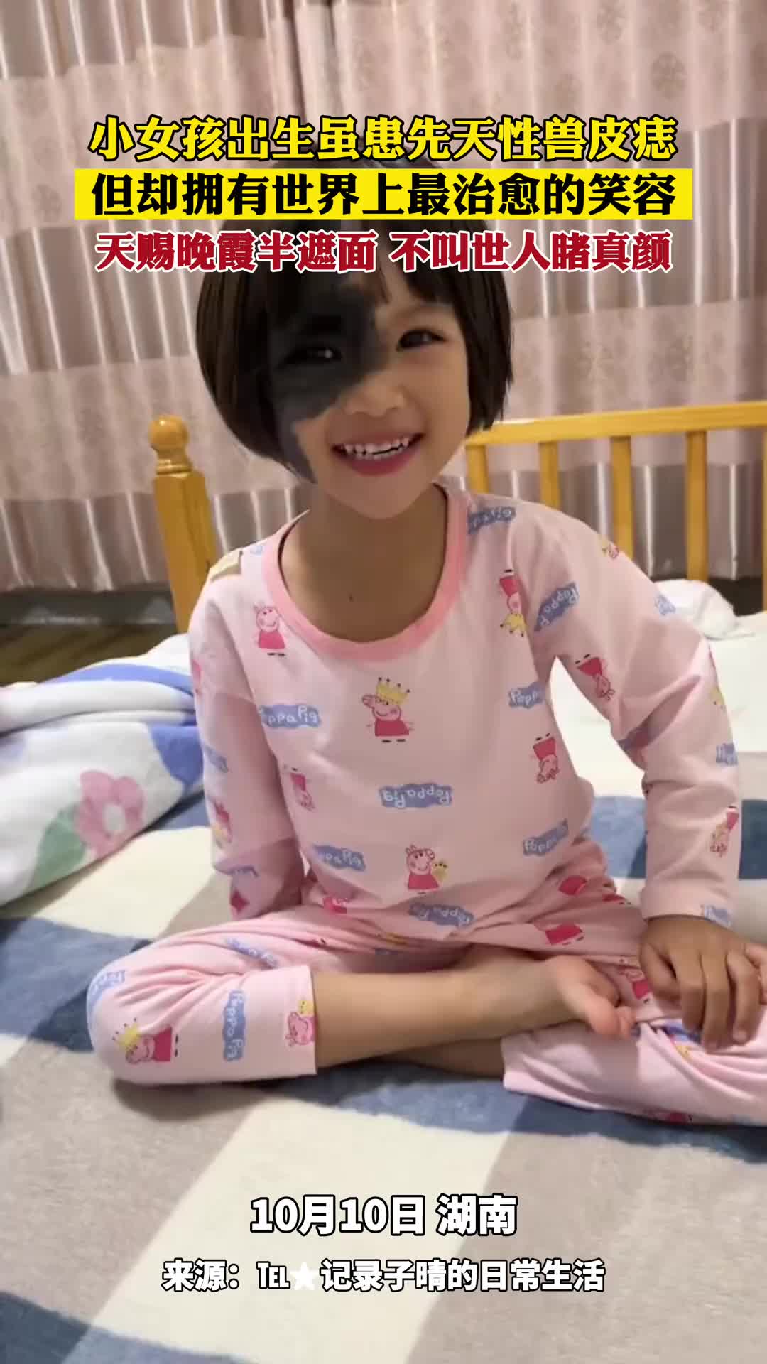 小女孩虽患先天性兽皮痣，但却拥有一个治愈的笑容