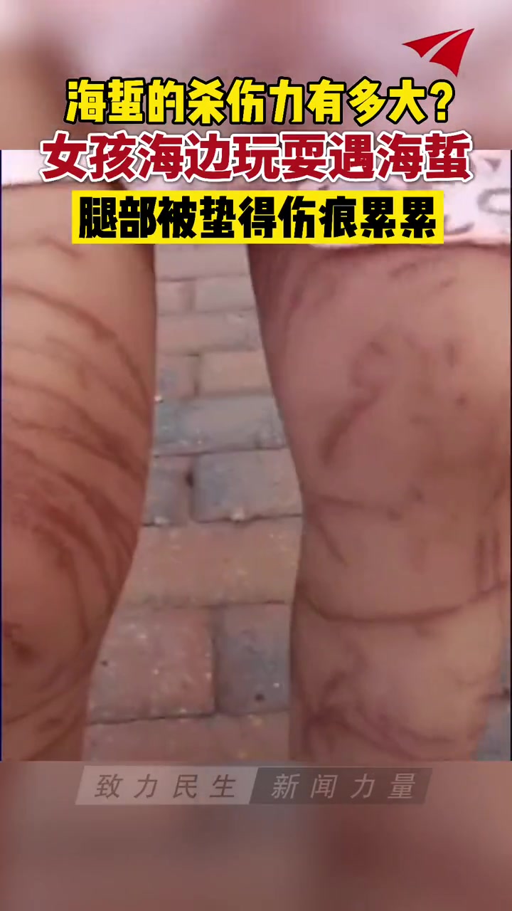 大连一女孩海边玩耍遇海蜇腿部被蛰得伤痕累累