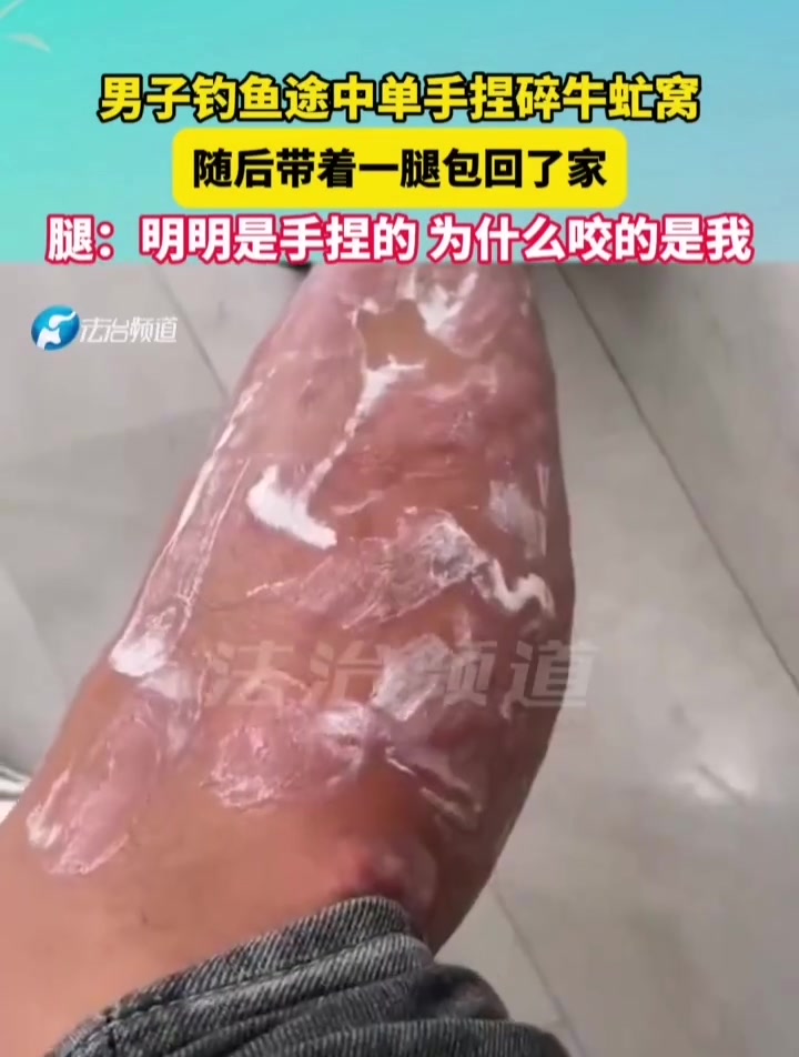 男子钓鱼途中单手捏碎牛虻窝随后带着一腿包回家
