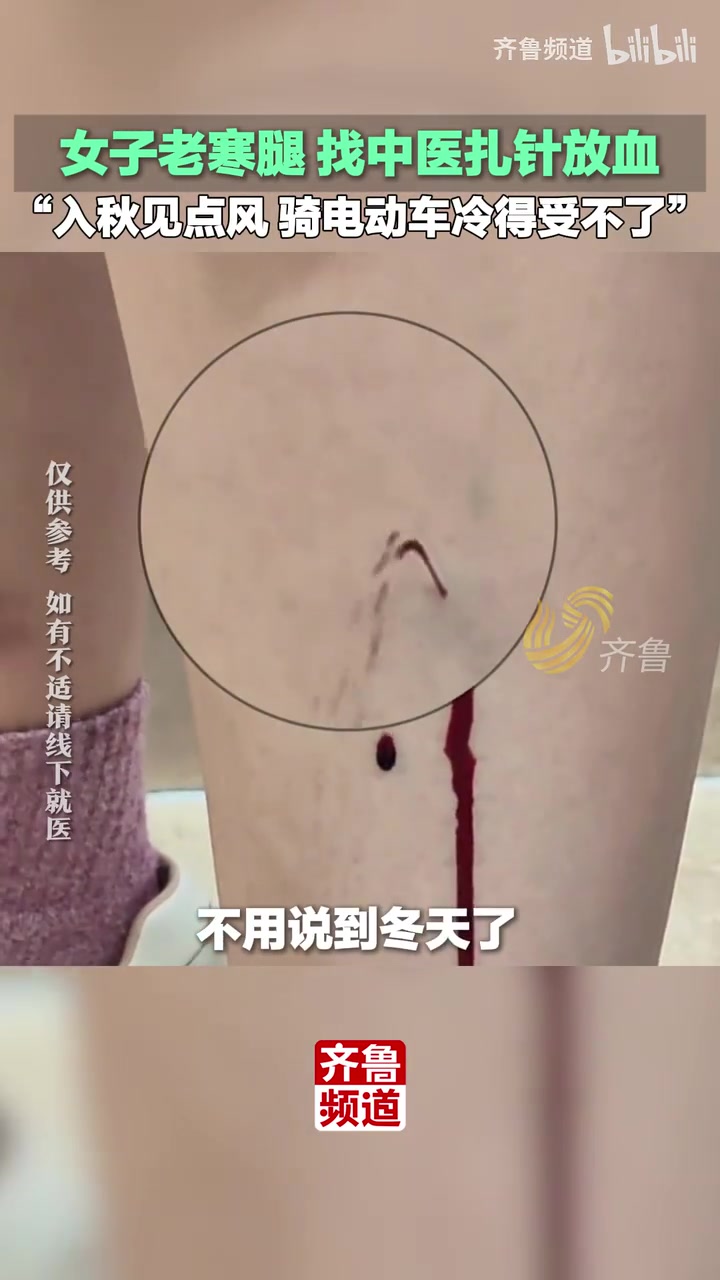 女子老寒腿，找中医扎针放血，别扎了大夫，我已经在找秋裤了！