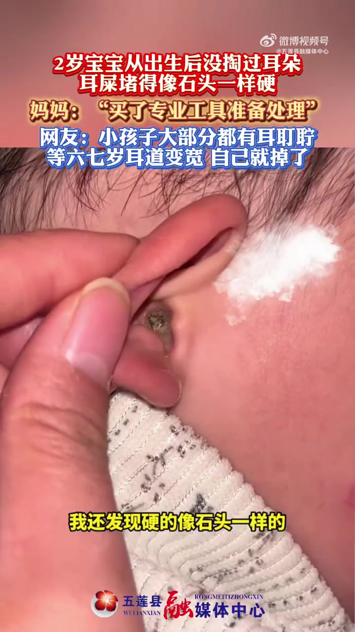 2岁宝宝从出生后没掏过耳朵，耳屎堵得像石头一样硬
