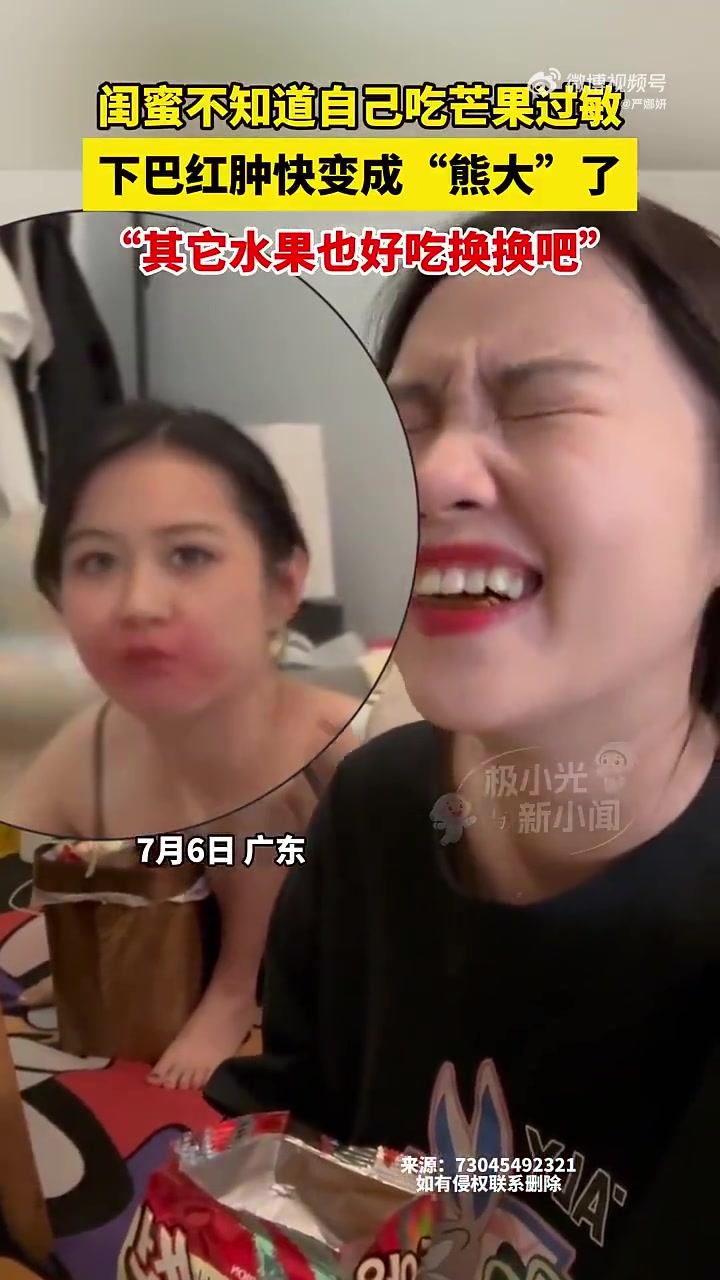 闺蜜不知道自己吃芒果过敏，下巴红肿快变成“熊大”了