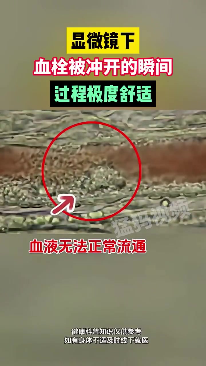 显微镜下，血栓被冲开的瞬间，过程极度舒适！