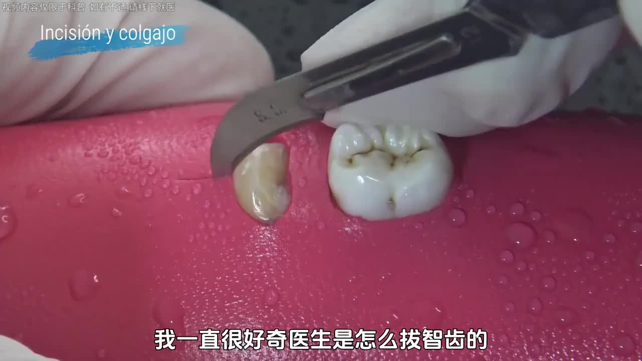 一直很好奇医生是怎么拔智齿的...