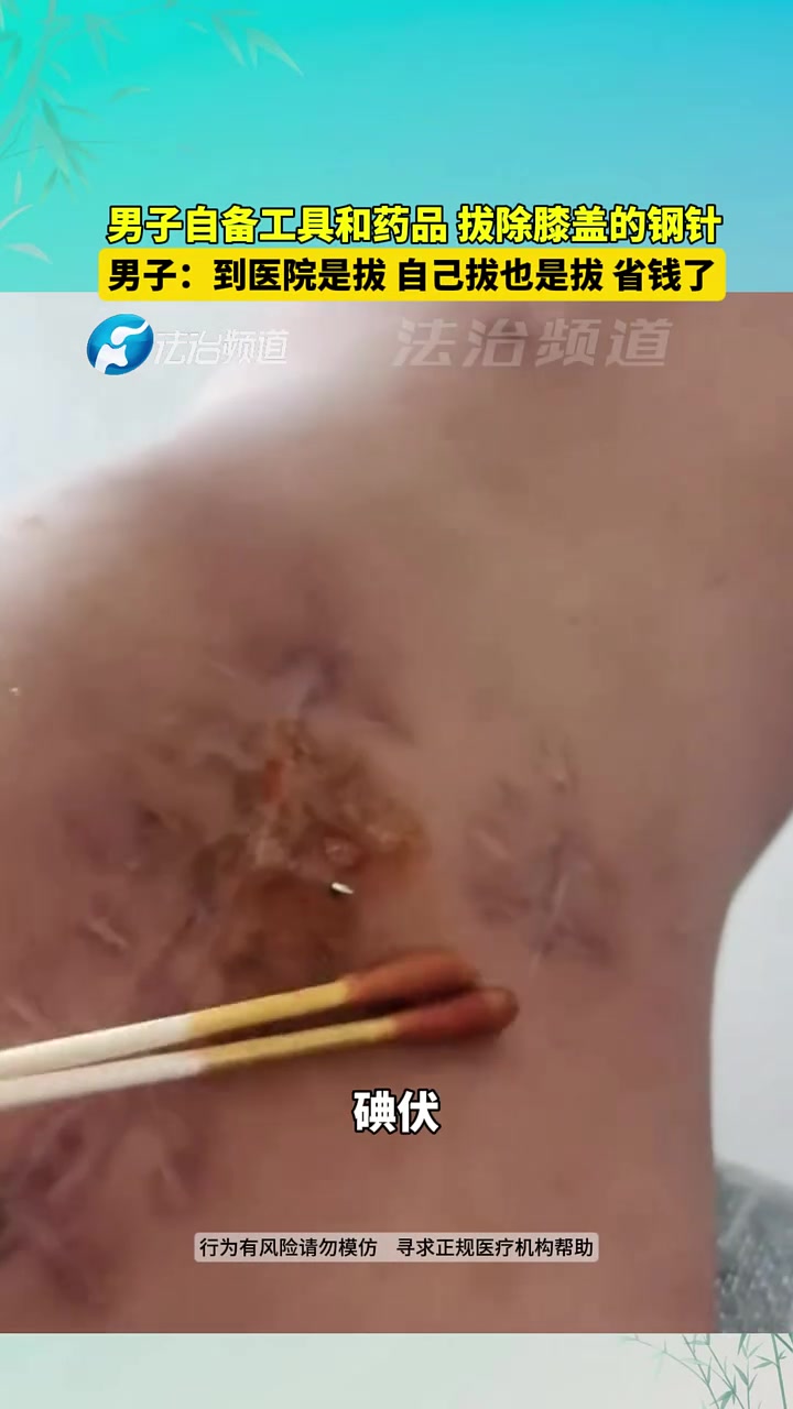 男子自备工具和药品拔出膝盖里的钢针