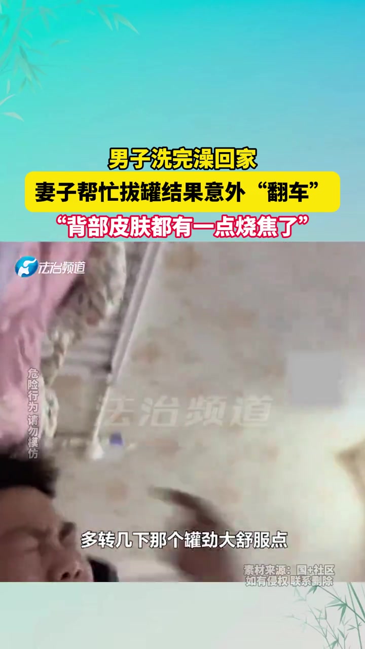 男子洗完澡回家妻子帮忙拔罐结果意外翻车背部皮肤都有一点烧焦了