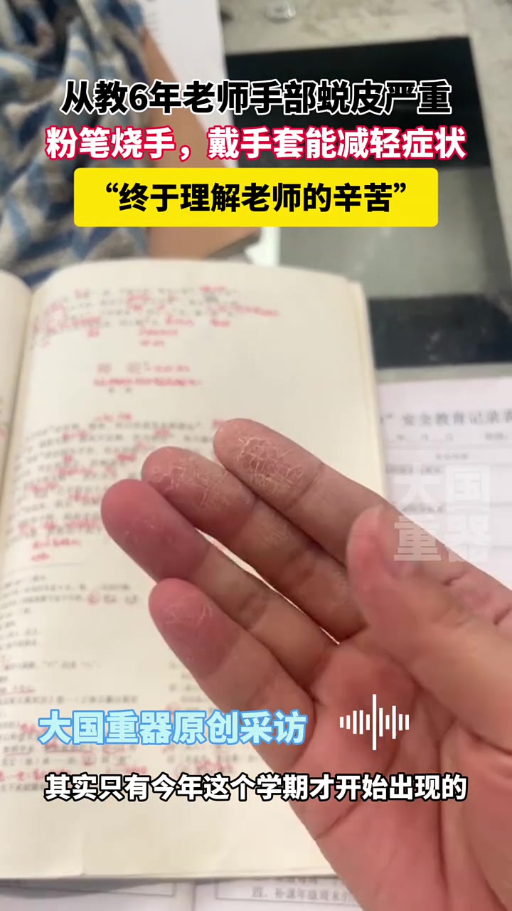 从教六年，老师手部脱皮严重