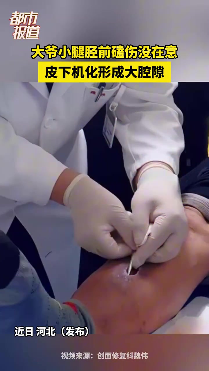 大爷小腿胫前磕伤没在意，皮下机化形成大腔隙