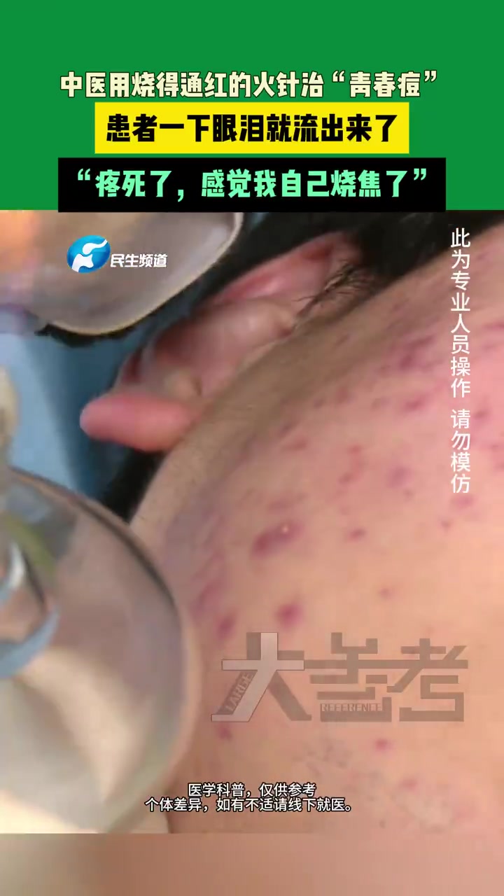 河南中医火针治“青春痘”！看着都疼！