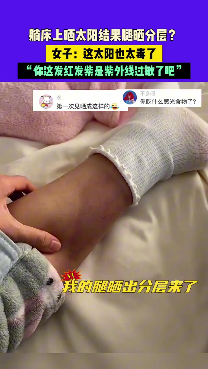 躺床上晒太阳结果腿晒分层女子：这太阳也太毒了